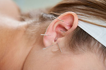 Acupuncture needles in a woman's ear