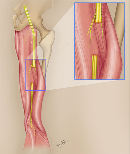 Injerto y transferencia de nervio