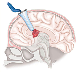 Sistema de acceso al cerebro ViewSite